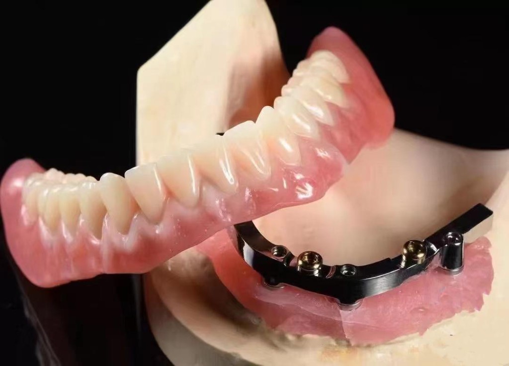 Implant-supported full arch denture beside a milled metal bar on a jaw model