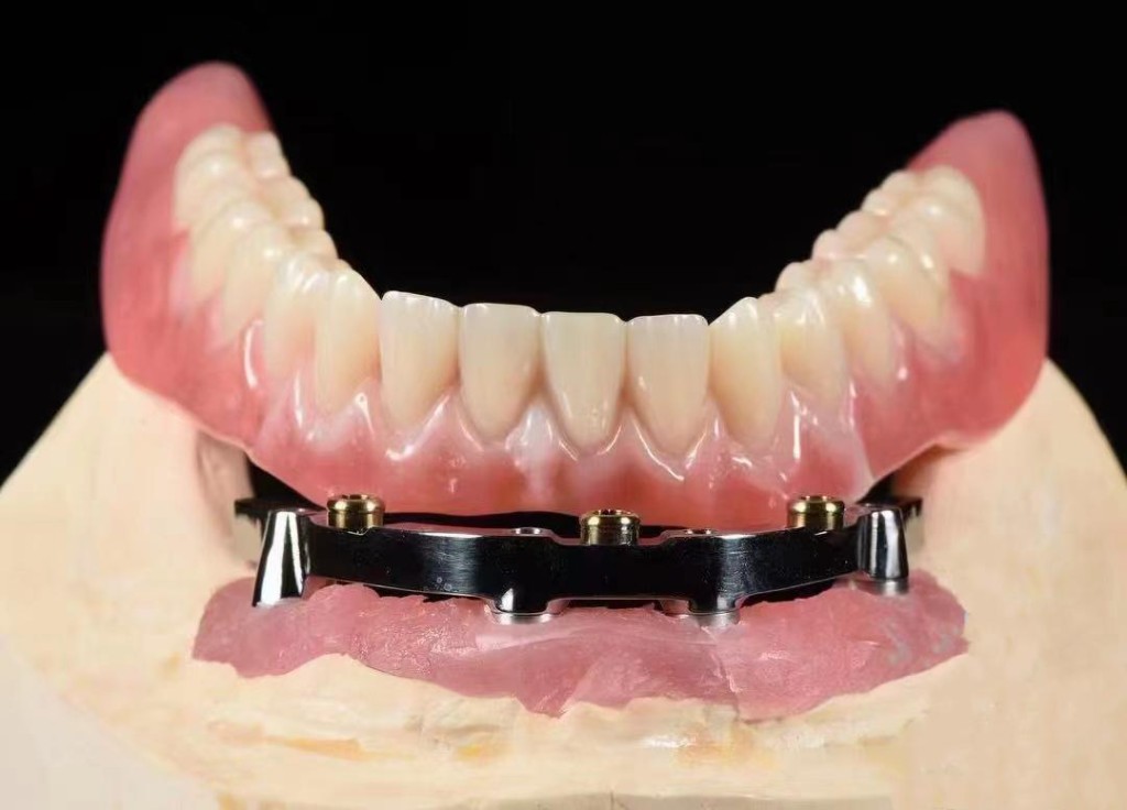 Lower overdenture lifted to show gold locator attachments on a metal bar