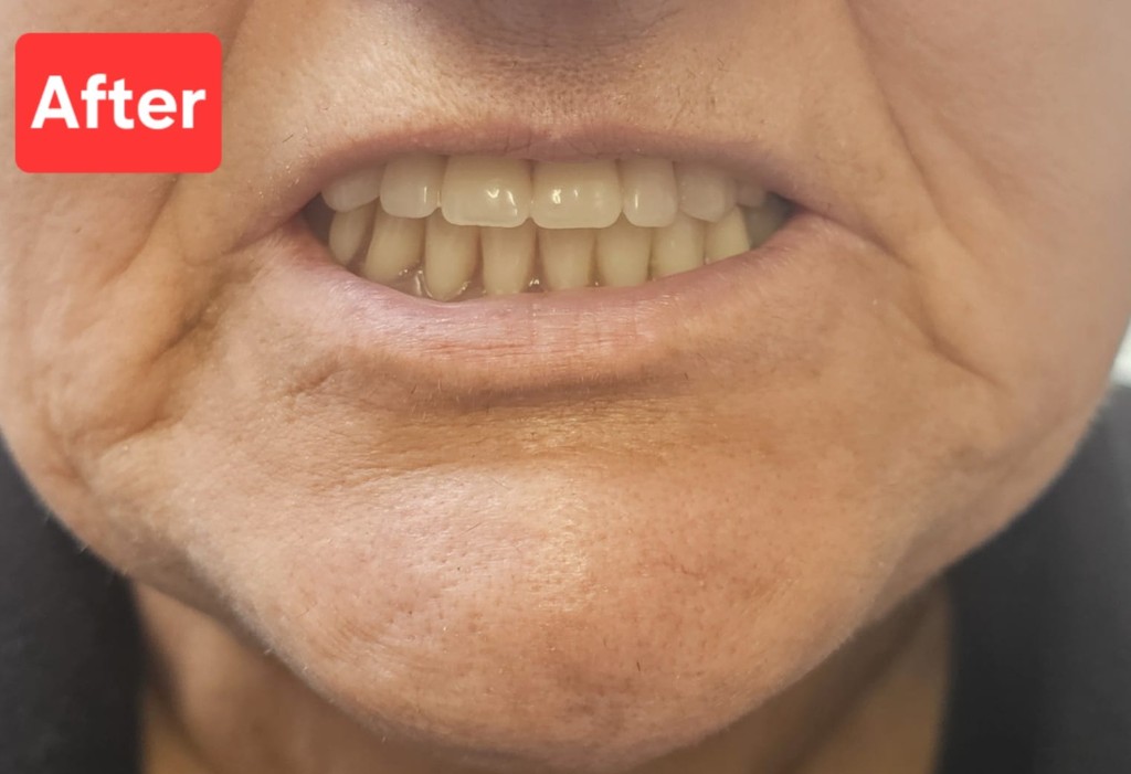 Patient smile after treatment: even, natural-looking teeth