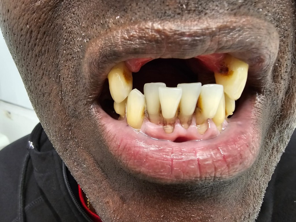 Open mouth before treatment showing decay and missing teeth