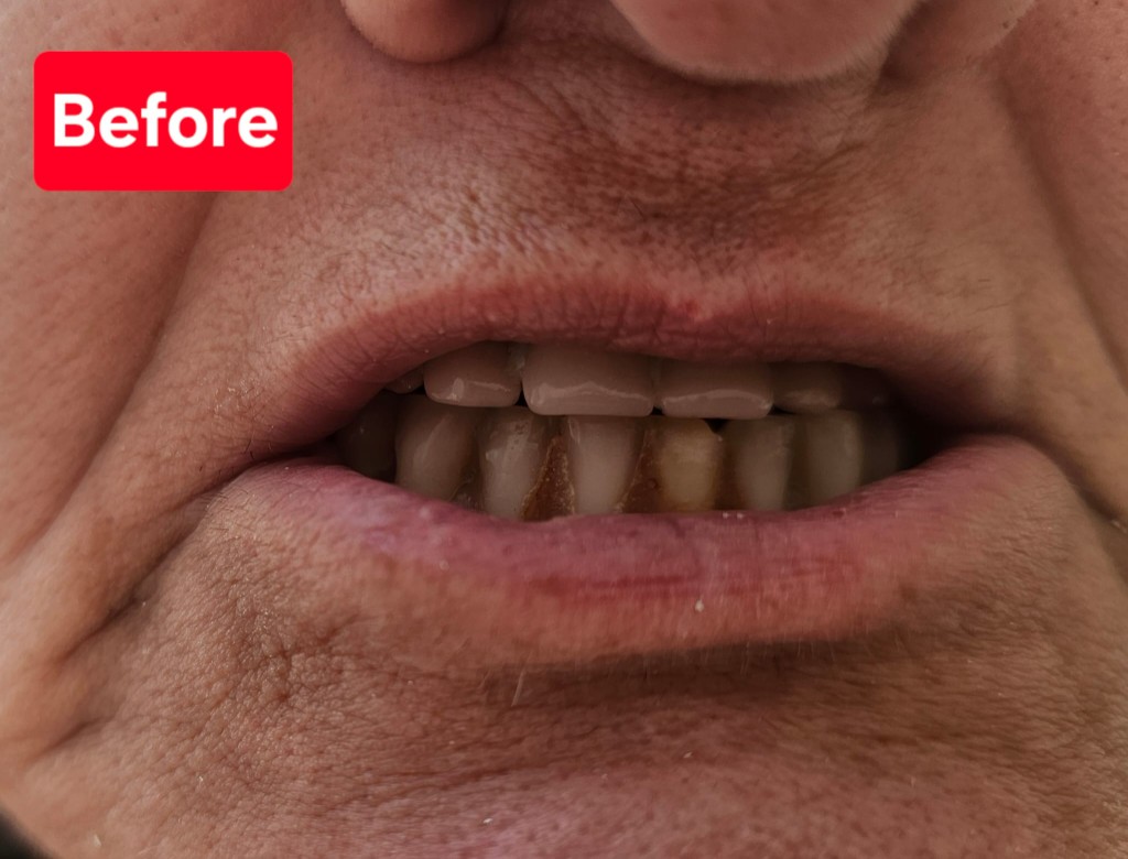 Patient smile before treatment: visible staining on lower teeth