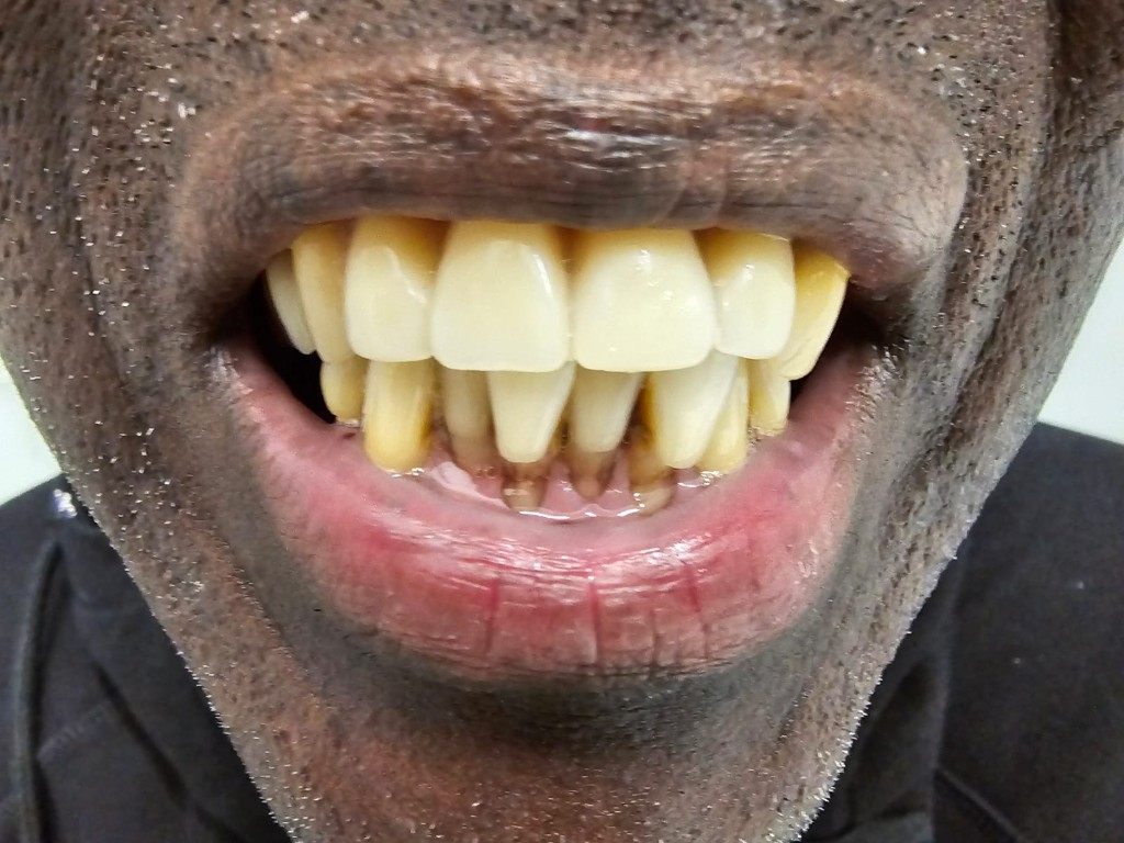 Smile showing restored upper arch and natural lower teeth