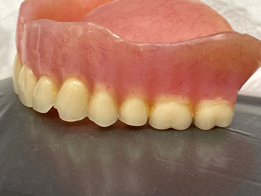 Implant-supported bridge on master cast