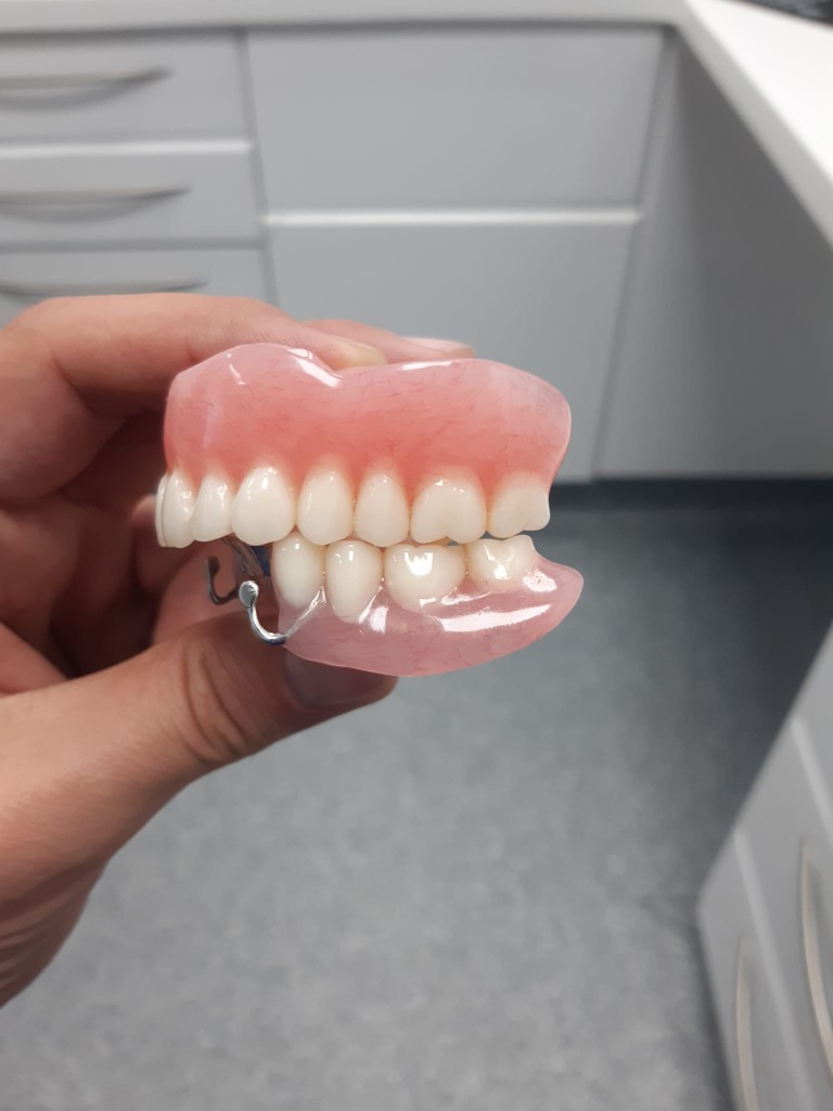 Partial upper denture with clasps